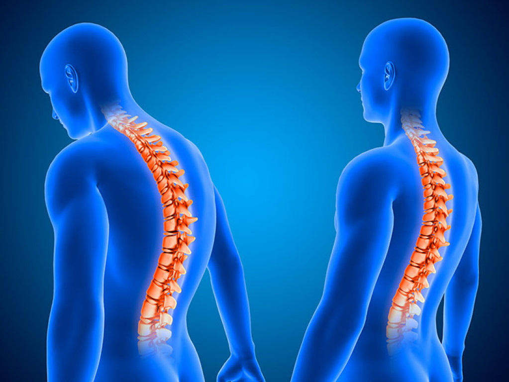 Douleurs dorsales : la cyphose du dos